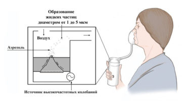 Regeln für die Verwendung eines Inhalators: Wie funktioniert es und warum?